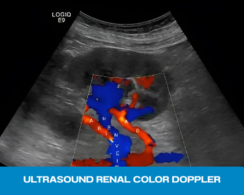 ULTRASOUND RENAL COLOR DOPPLER